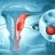 Ovarian cyst removal