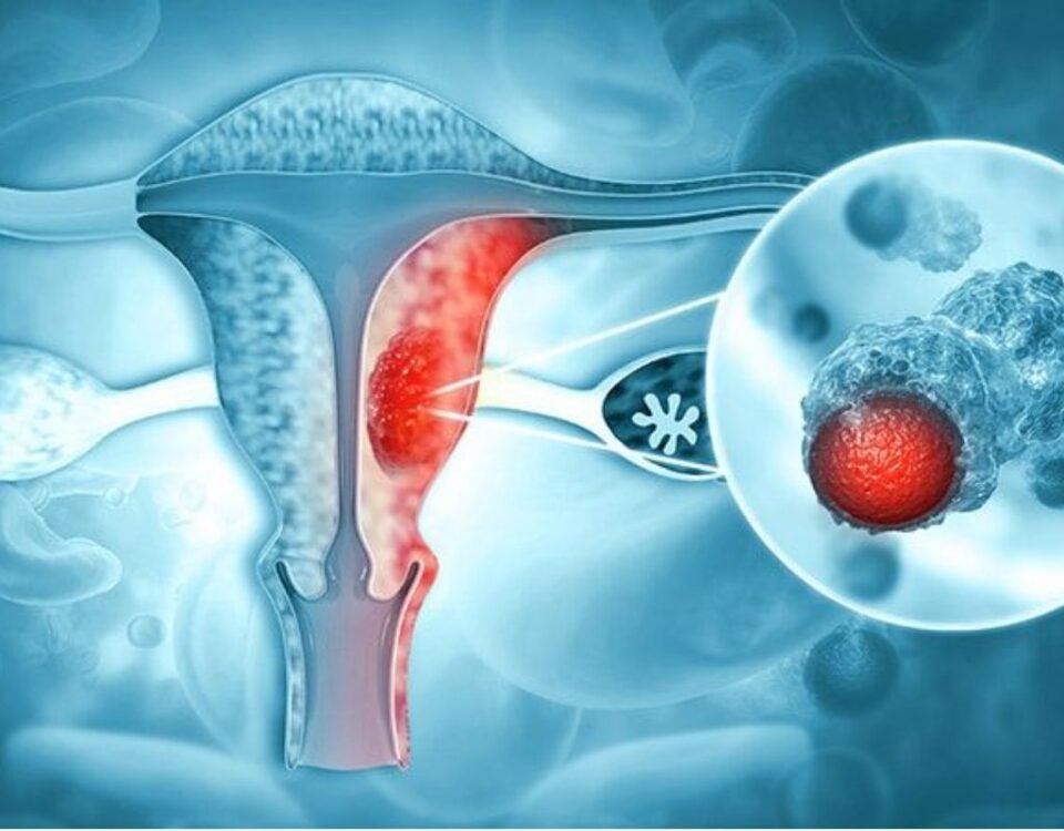 Ovarian cyst removal